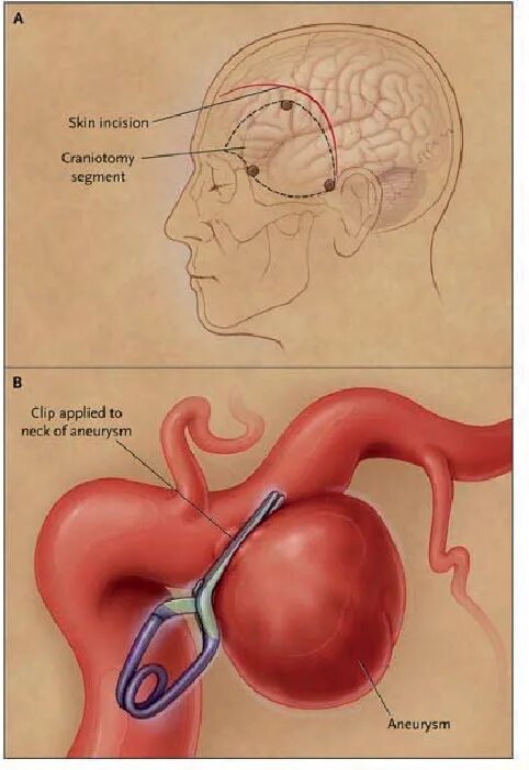 Аневризма мозга отзывы. Клипирование аневризмы. Клипирование сосудов головного мозга. Клипирование мешотчатой аневризмы. Клипса для аневризмы головного мозга.