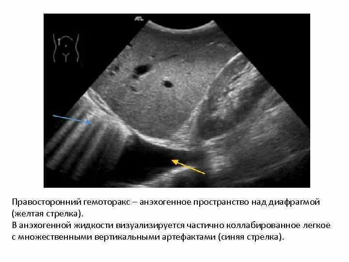 Аваскулярное образование в печени. Анэхогенная структура УЗИ. Гемоторакс эхография. Анэхогенное образование в печени на УЗИ.