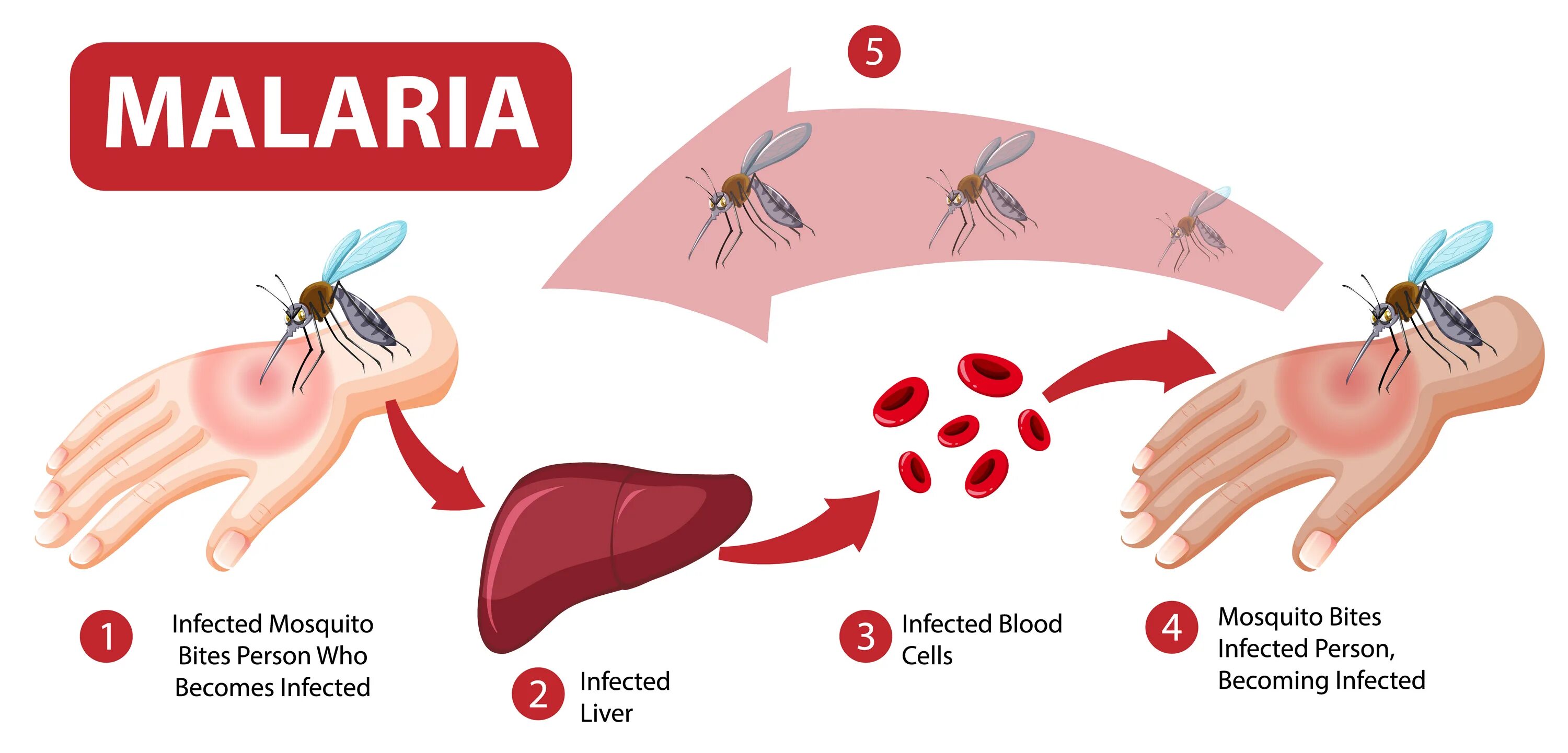 Малярия инфографика. Вектор малярия. Малярия иллюстрация вектор.