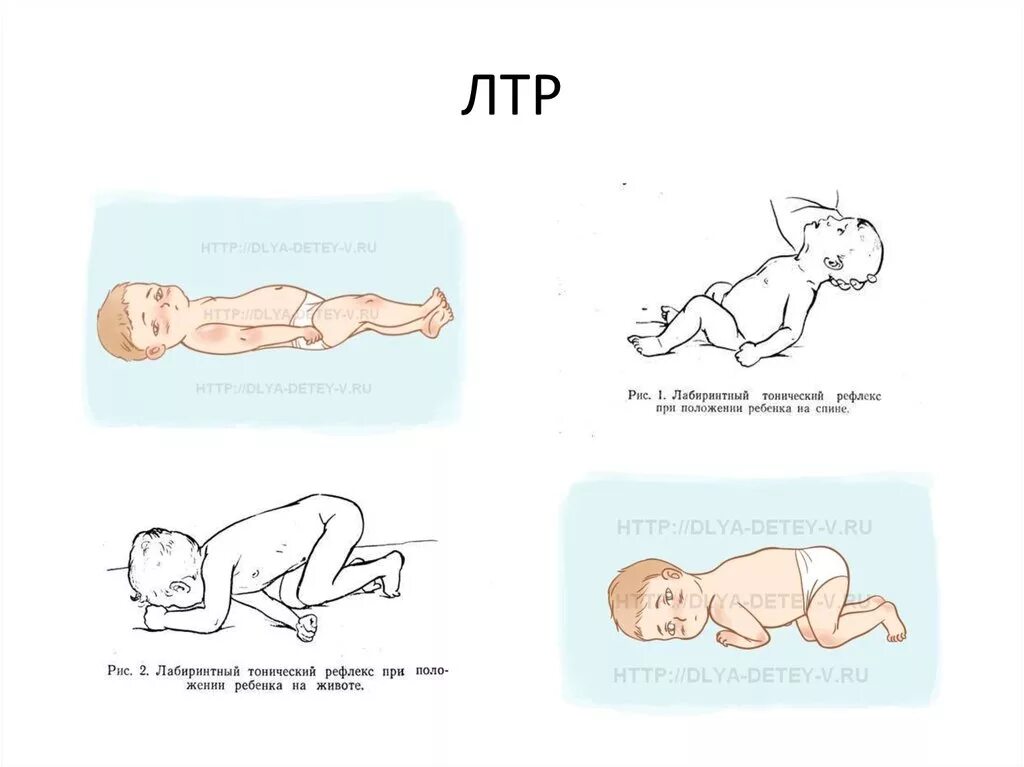 Тонический рефлекс - лабиринтный тонический рефлекс (лтр). Лабиринтный тонический рефлекс у новорожденных. Лабиринтный тонический рефлекс при ДЦП. Лабиринт тонический рефлекс при ДЦП. Как правильно выкладывать новорожденного на живот