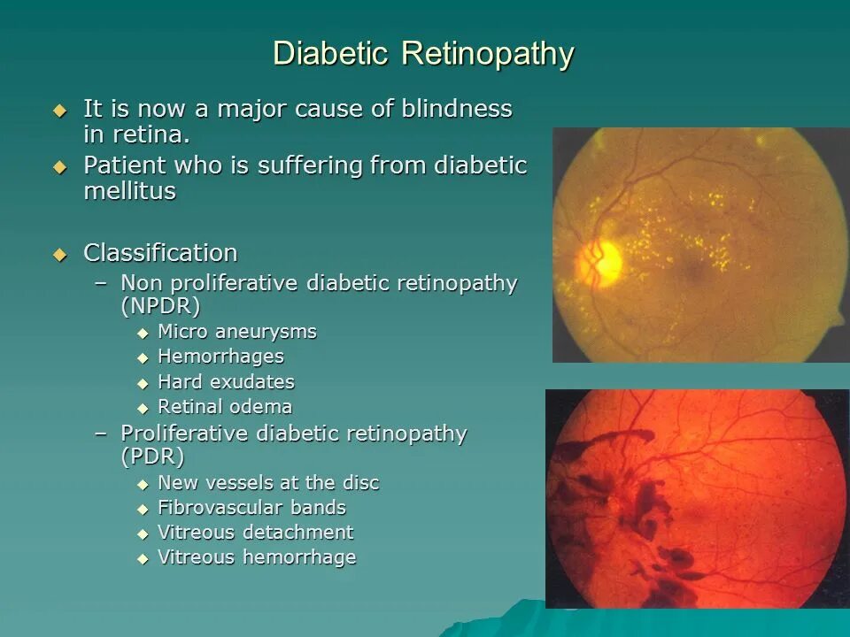 ETDRS диабетическая ретинопатия.