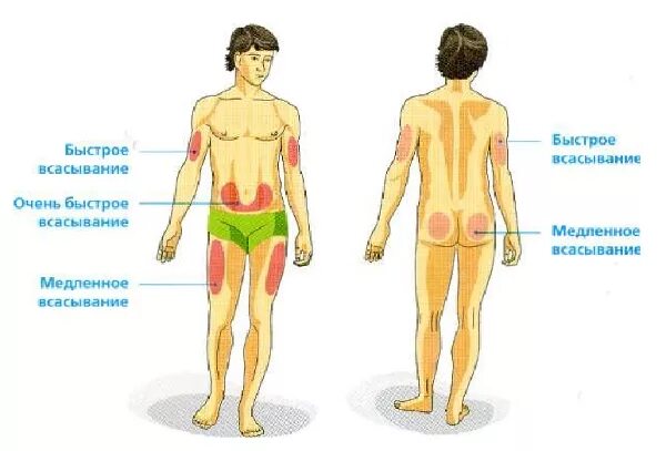 Введение инсулина при сахарном диабете. Сахарный диабет 1 типа места введения инсулина. Места для инъекций инсулина короткого действия. Места для инъекций инсулина длительного действия. Зоны укола инсулина.