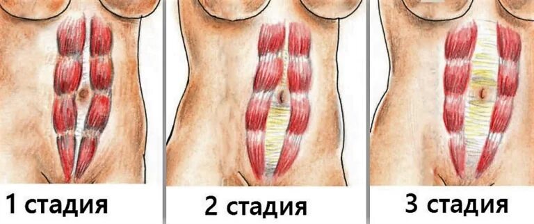 Прямые мышцы живота у мужчин. Диастаз мышц белой линии. Диастаз прямых мышц брюшного пресса. Диастаз мышц живота 2 степени.