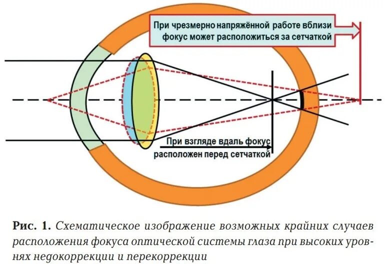 Фокусировка глаза человека. Изображение на сетчатке глаза. Фокус оптической системы глаза. Фокусирует изображение на сетчатку. Оптическая система объектива.