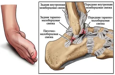 Растяжение связок пятки