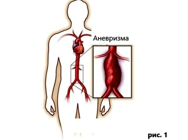 Аневризма брюшной аорты симптомы лечение. Аневризма брюшной аорты схема. аневризма брюшной аорты аускультация. схема аневризмы брюшной аорты. клипирование аневризмы брюшной аорты.