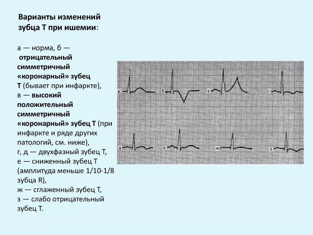 Ишемия т. Ишемия миокарда на ЭКГ. Коронарный зубец т на ЭКГ. Высокий коронарный зубец т на ЭКГ. Признаки ишемии миокарда на ЭКГ.
