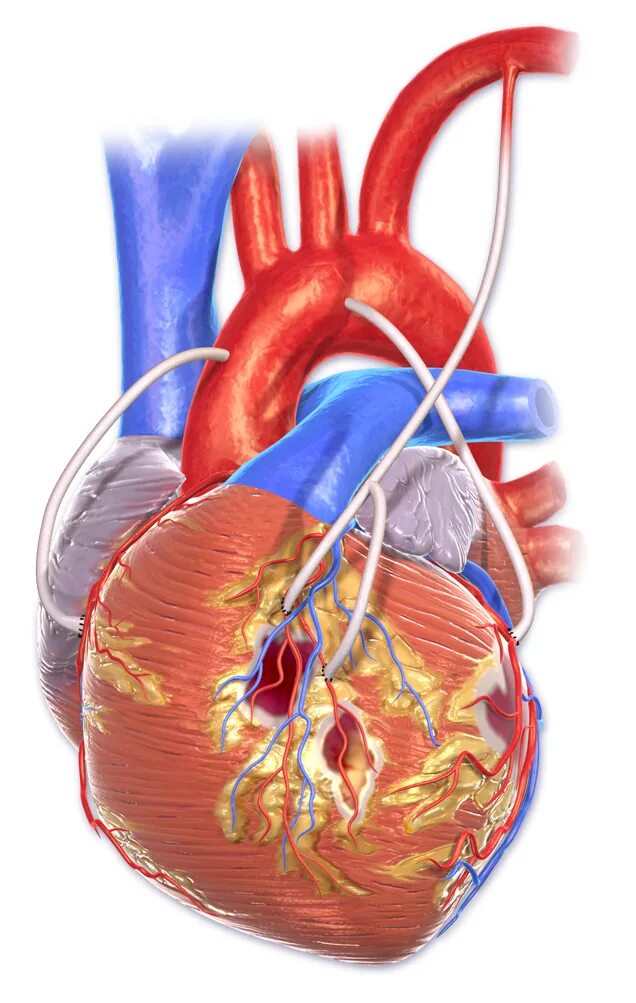 Операция шунтирование артерии. Коронарное шунтирование сосудов сердца. Шунтирование сердца шунты. Аорта корональное шунтирование. Операция коронарное шунтирование сосудов сердца.