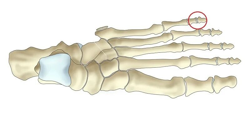 Кость мизинца на ноге перелом. Перелом кости стопы мизинец. Кости стопы человека переломы.
