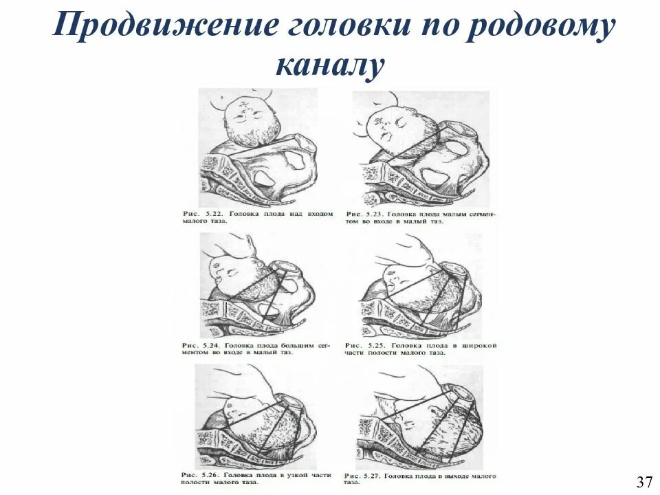 Продвижение головки плода по родовому каналу. Оценка продвижения головки плода по родовому каналу. Продвижение плода по родовым путям. Бишопу акушерство