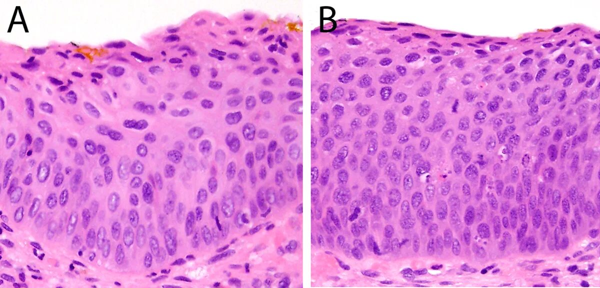 Дисплазия эпителия гистология. Дисплазия шейки матки гистология. Метаплазия цервикального эпителия. Плоскоклеточная метаплазия эпителия бронха. Рак in situ шейки