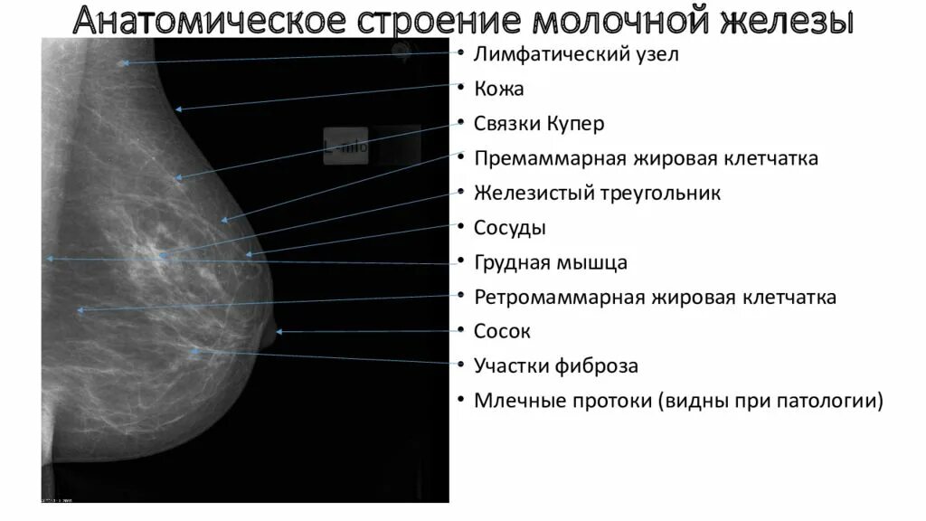 Шишка в грудной железе у женщин