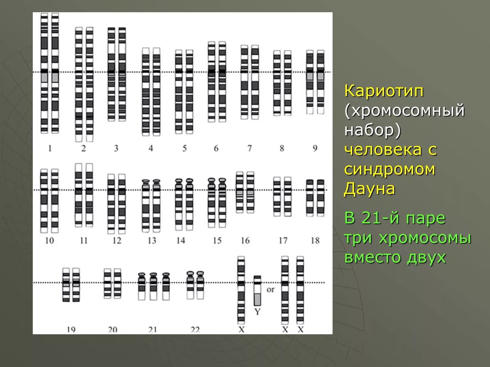 Кариотип человека с синдромом Дауна. Синдром Дауна набор хромосом. Хромосомный набор кариотип человека. Набор хромосом при синдроме Дауна.