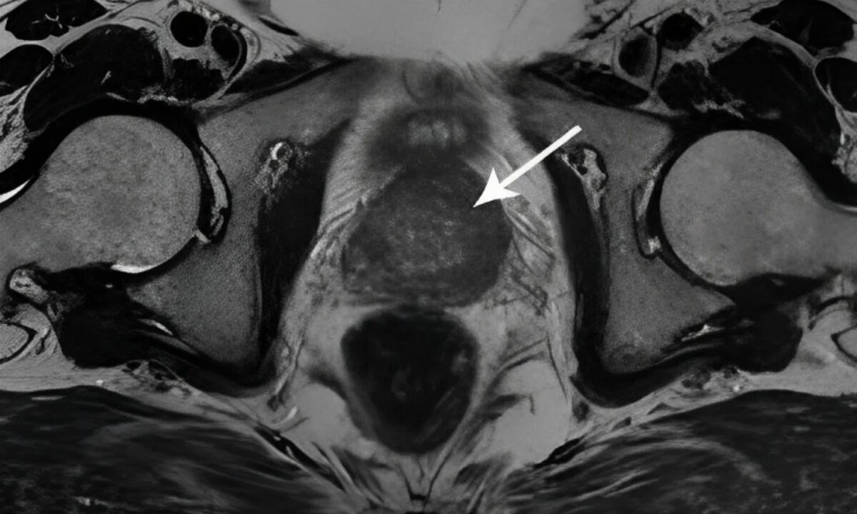 Кт малого таза с контрастом у мужчин. Предстательная железа на томограмме. Карцинома мрт предстательной железы. Аденома предстательной железы мрт. Предстательная железа MRT.
