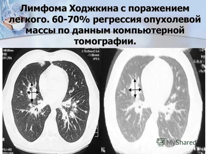 Лимфома средостения рентген. Лимфома ходжкина легкие. Лимфогранулематоз средостения рентген. Лимфома ходжкина легкие кт. Лимфома ходжкина легкие.