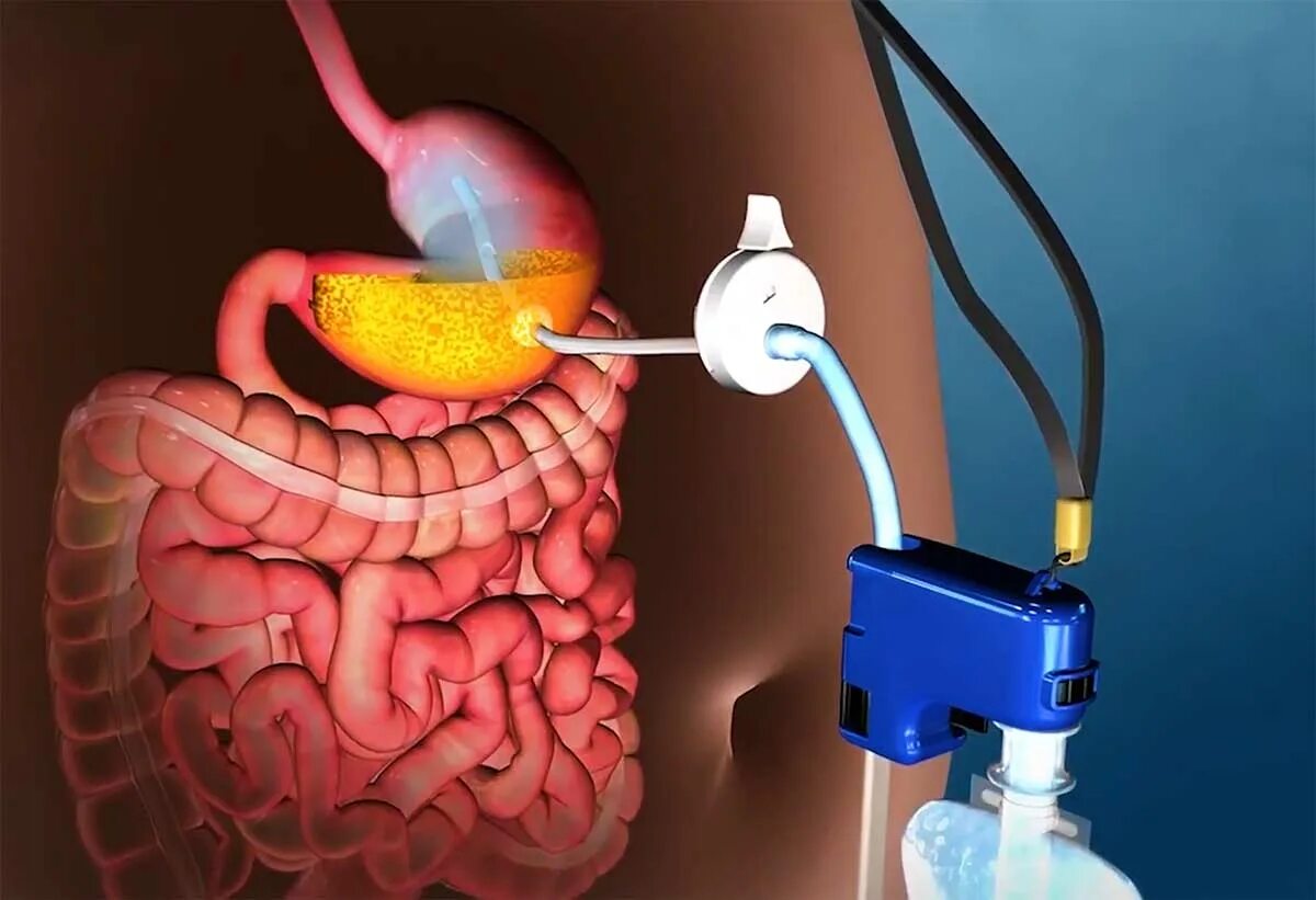 Удаление воздуха из желудка. Искусственный желудок. Трубочка в желудок для еды.