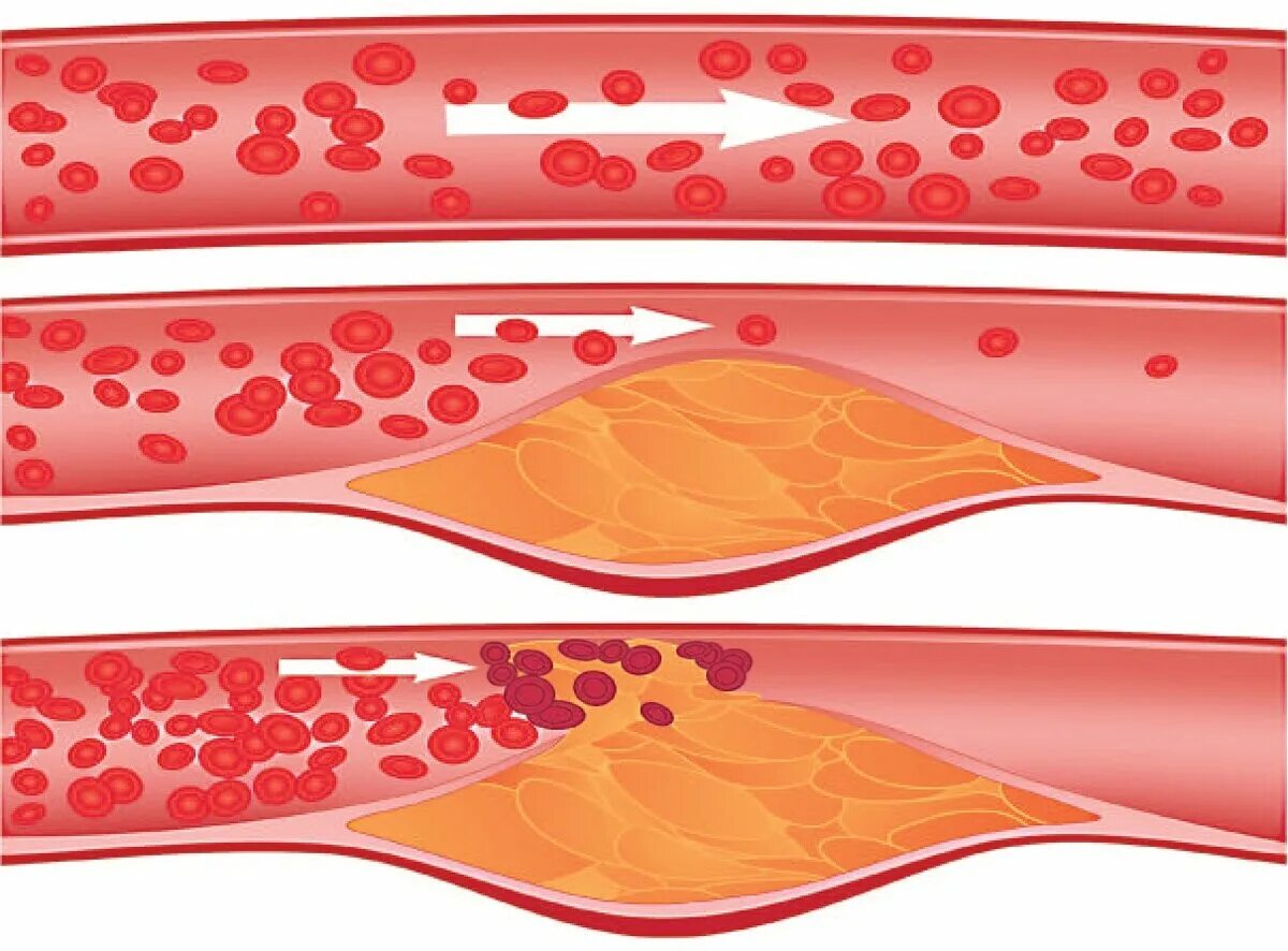 От бляшек и тромбов как очистить. Разрыв кровеносного сосуда.