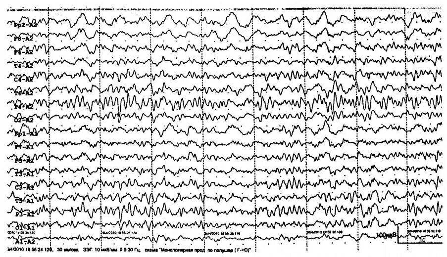 Потенциал ээг. Полифазные потенциалы на ЭЭГ. Высокоамплитудные Дельта волны на ЭЭГ. Fast activity на ЭЭГ. ЭЭГ при звуковой стимуляции.