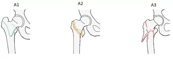 Межвертельный перелом шейки бедра. Перелом шейки бедра Вертельный снимок. Чрезвертельный перелом шейки бедра в пожилом возрасте. Переломы классификация Pipkin. Срок лечения шейки бедра