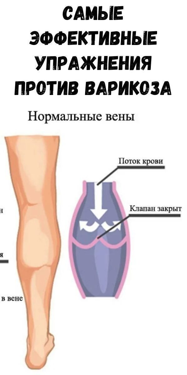 Расширение вен упражнения. Варикозное расширение вен. Упражнения против варикоза. Упражнения против вар коза. Упражнения против варикоза вен.