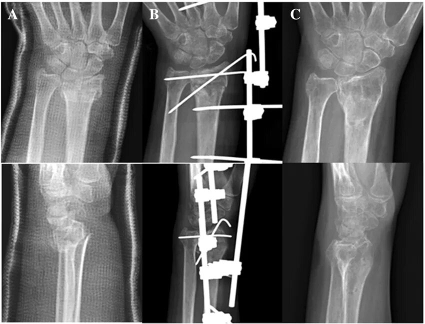 Radius fracture. Чрескожный металлостеосинтез. external fixation device treatment of distal fractures.