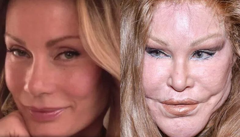 Жена сделала пластические операции. Джослин вильденштейн 2023. Неудачные пластические операции. Джослин вильденштейн 2022. Джослин вильденштейн 2018.