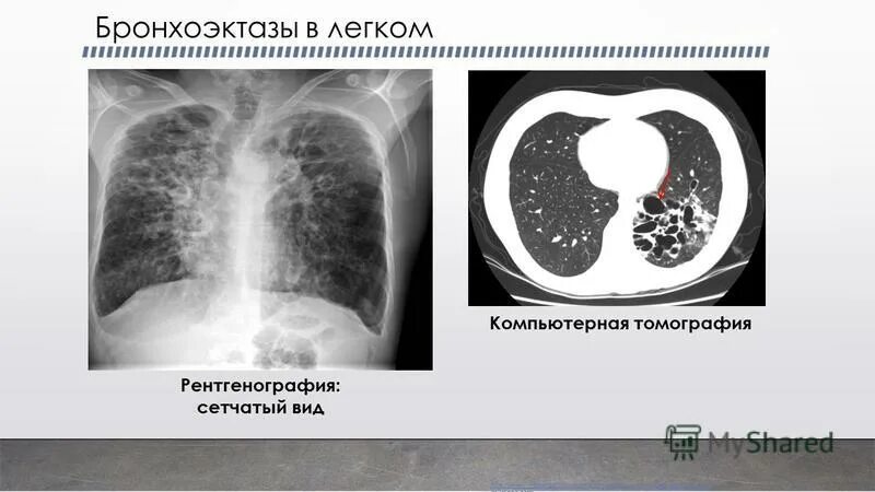 полость в легком на кт