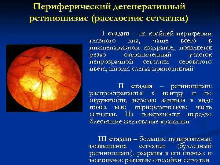 Миопический конус глазное дно. Глазное дно миопическая стафилома. Миопическая стафилома сетчатки. Дегенеративный ретиношизис сетчатки. Миопический конус
