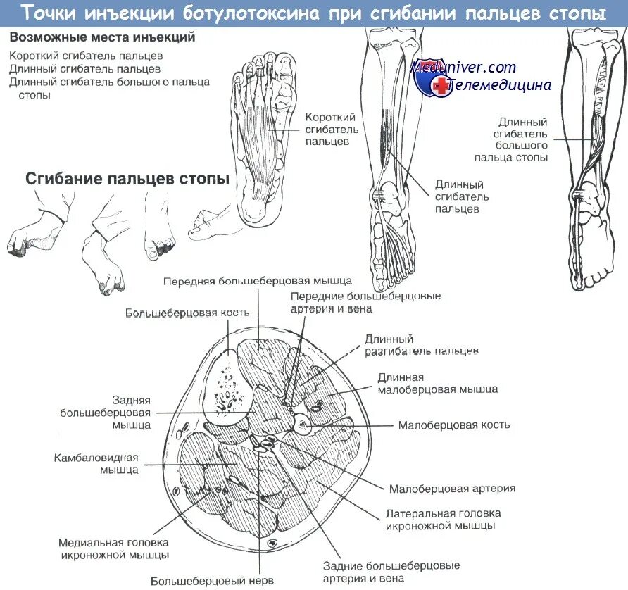 Ботулинотерапия пальцев стопы. Точки ботулинотерапии при дистонии стопы. Камбаловидная мышца на УЗИ ботулинотерапия. Сгибатели большого пальца стопы точки для введения ботокса. Точка уколова