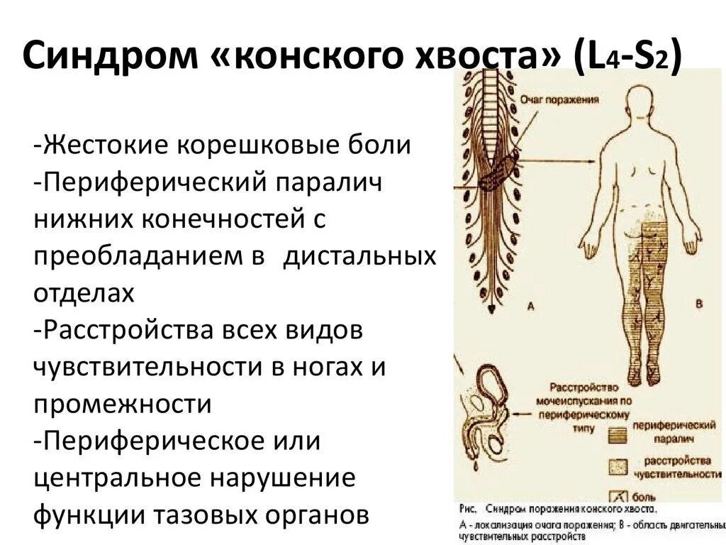 Поражение корешковых нервов. Синдром поражения Корешков конского хвоста. Спинной мозг строение конский хвост. Симптомы поражения конского хвоста. Признаком повреждения Корешков конского хвоста является.