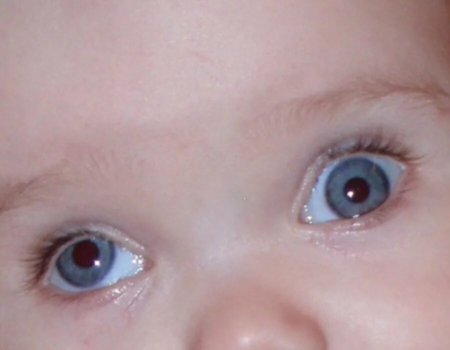 Почему у новорожденного глазки. Косоглазие гипотропия. Косоглазие (страбизм) у новорожденного. Глаза новорожденного. Глаза у детей до года.