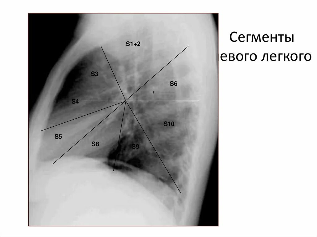 6, 10 Сегмент правого легкого. 9 Сегмент левого легкого. 6 Сегмент левого легкого. S1 s2 сегмент лёгкого.