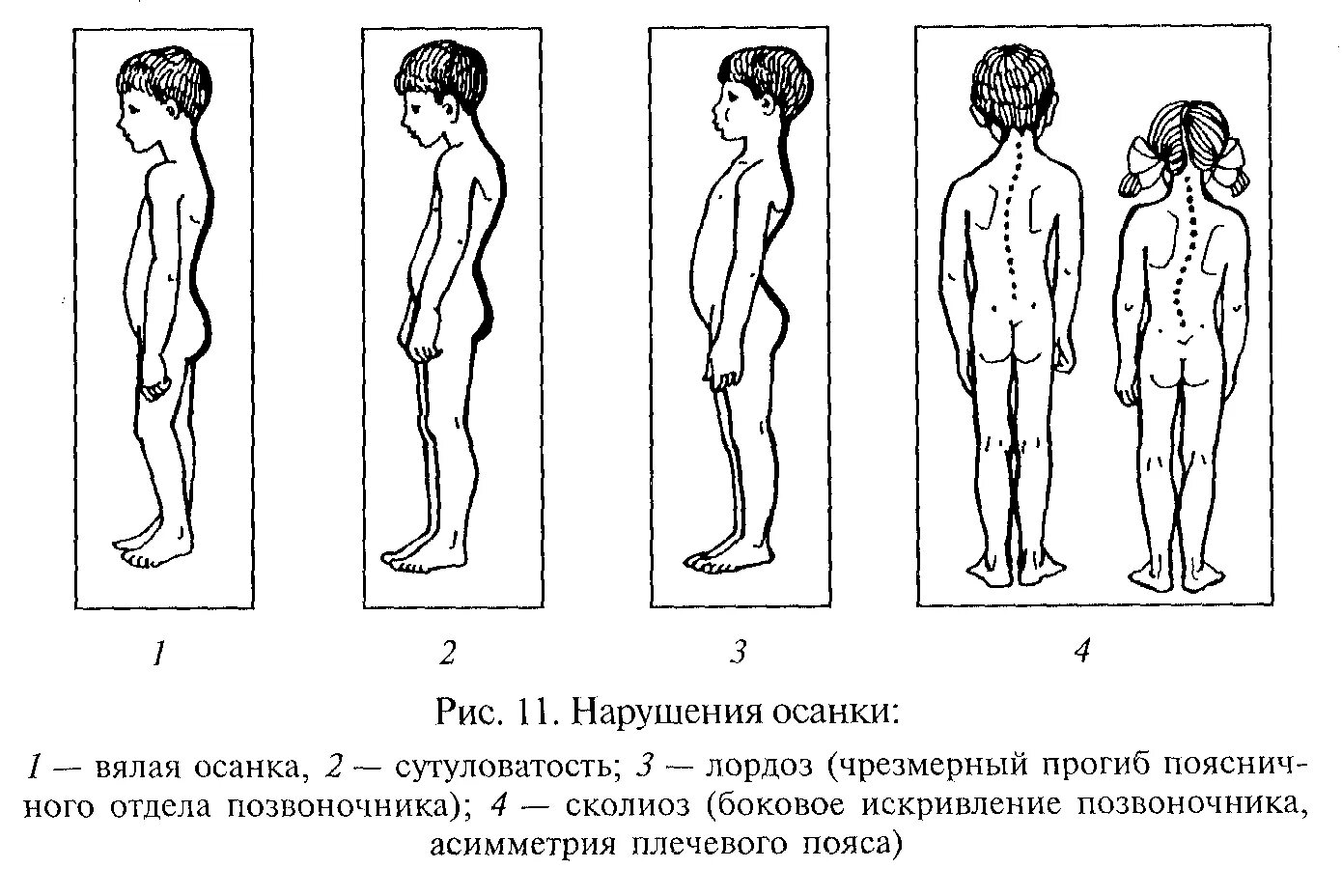 Искривление бывает. Виды нарушения осанки у детей. типы нарушений осанки сутулость. нарушение осанки, искривление позвоночника. причины формирования неправильной осанки у детей.