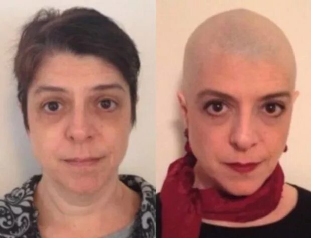 Люди до и после химиотерапии. Люди после химиотерапии до и после. Внешность до и после химиотерапии.