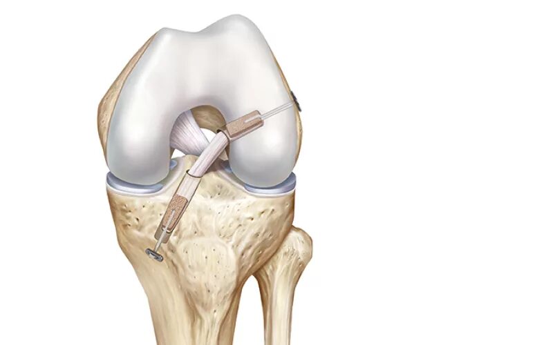 Полный разрыв передней крестообразной. Мениски коленного сустава анатомия. ПКС (передняя крестообразная связка). Операция пластика ПКС коленного сустава.