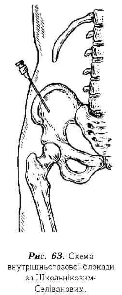 Школьникову Селиванову блокада. Тазовая блокада по Школьникову Селиванову. Блокада по Школьникову-Селиванову техника. Внутритазовая новокаиновая блокада по Школьникову. Школьникова селиванова