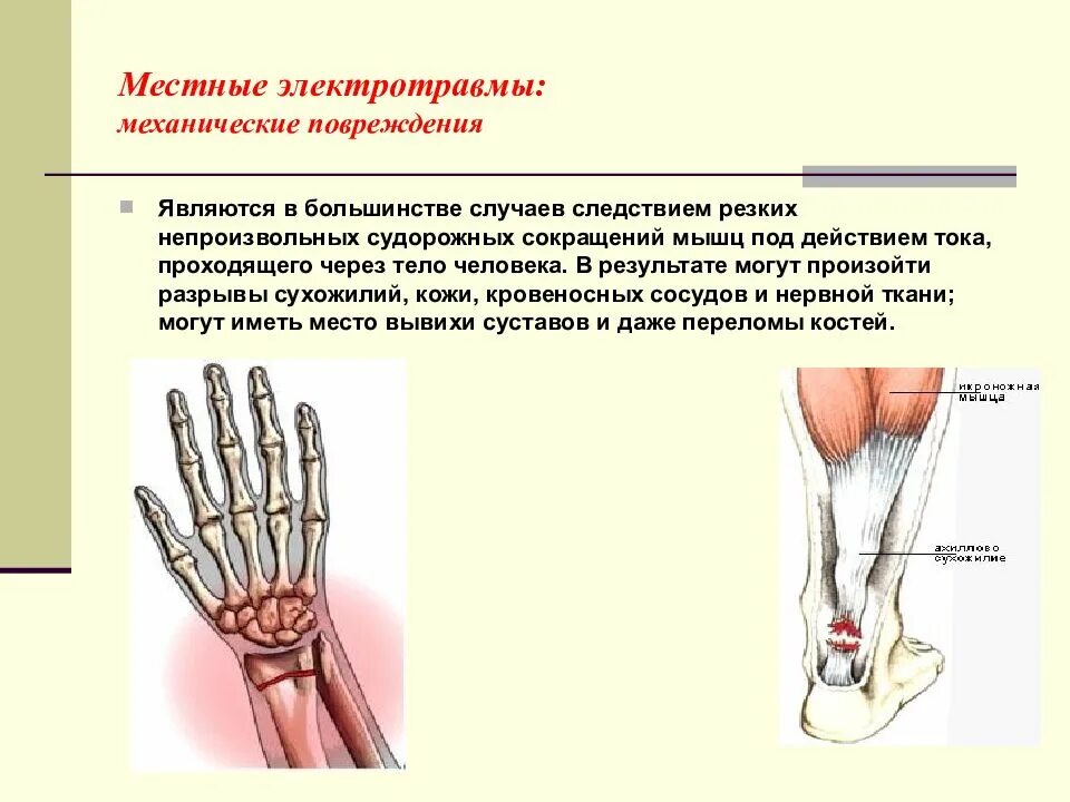 Напряжение сухожилий
