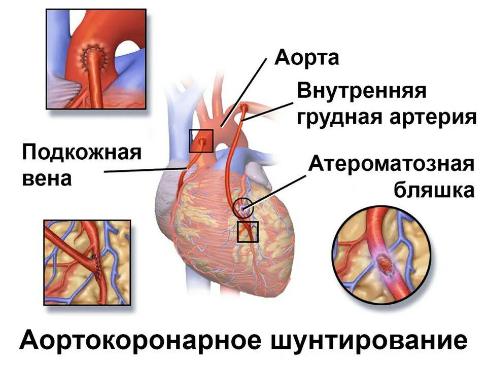 Шунтирование коронарных артерий. Коронарное шунтирование сосудов сердца. Шунт при инфаркте миокарда. Коронарное шунтирование сердца при инфаркте. Что такое шунтирование сердца и сосудов