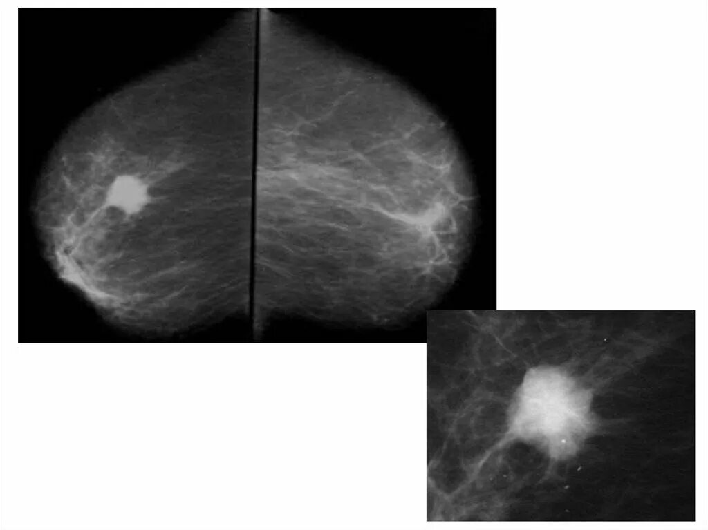 Маммография молочных желез 4. Карцинома молочной железы маммография. Фиброаденома молочной железы маммография. Рик молочной железы маммографич. Липогранулема маммография.