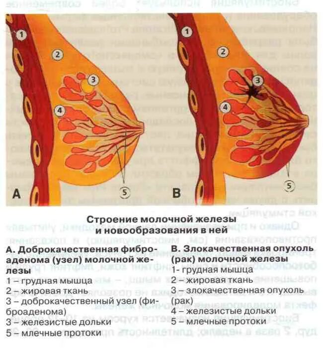 Способы увеличения груди без имплантов