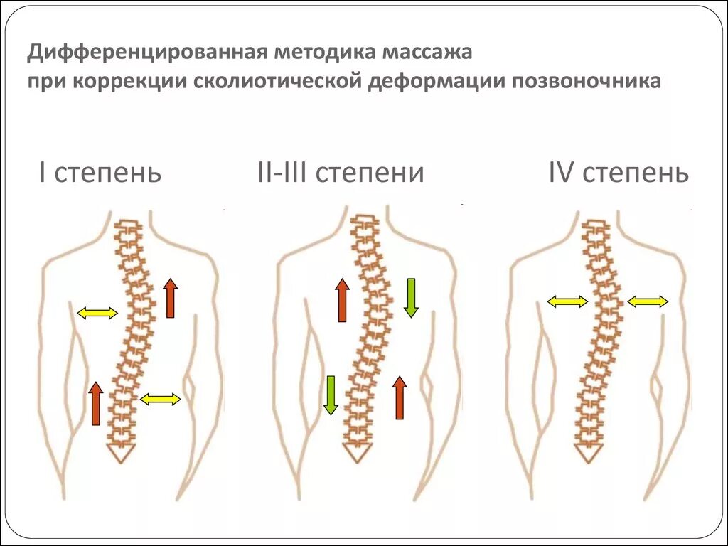 Искривление позвоночника сколиоз 1 стадия. Сколиоз позвоночника степени 1 степени. Сколиоз 1 степени схема. Сколиоз позвоночника 2-3 степени. Сколиоз 2 степени это