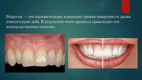 Рецессия операция