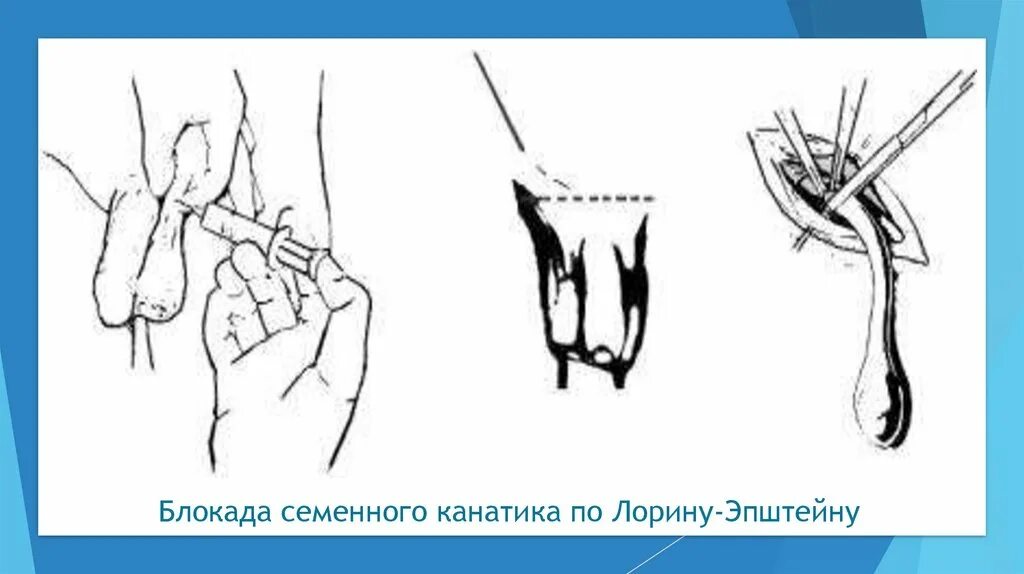 Блокады половые. Новокаиновая блокада по Лорин-Эпштейну. Блокада семенного канатика. Блокада семенного канатика по Лорин-Эпштейну техника. Новокаиновая блокада семенного канатика.