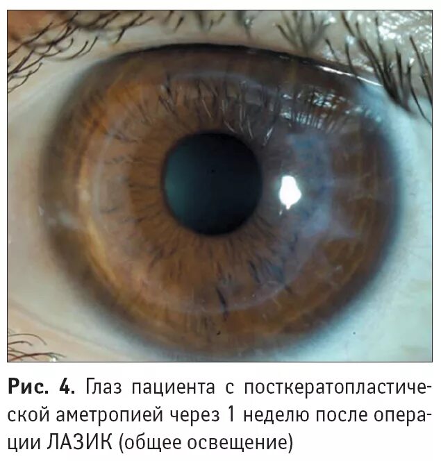 Глаза после фемтоласик. Глаза после фемтоласик. Фемто проскан ласик. Лазерная коррекция зрения фемто ласик. Femto lasik этапы операции.