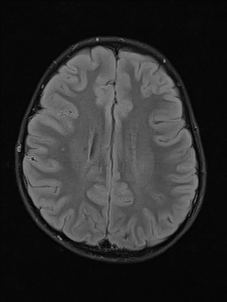 Ишемия мозга мрт. Ишемия головного мозга мрт т2. Мигрень на мрт головного мозга. Мрт снимок при мигрени. Снимок мрт головного мозга при энцефалопатии.