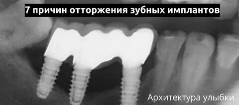 Как приживаются импланты отзывы