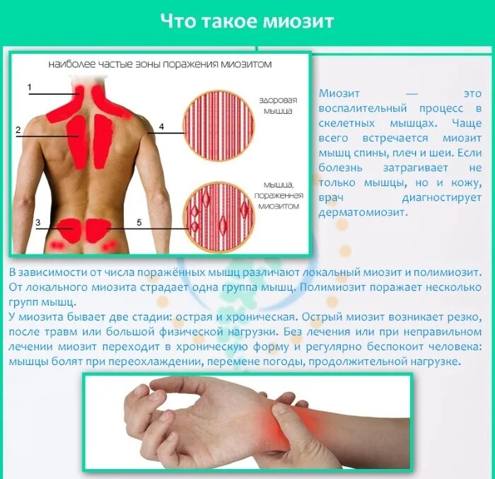 Продула поясницу боли. Воспаление мышц миозит. Мышечный миозит поясницы.