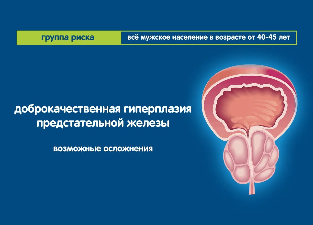 Простата форма. Аденома предстательной железы и ДГПЖ. Простата гиперплазия предстательной железы. Стромальная гиперплазия предстательной железы. Доброкачественная гиперплазия предстательной железы (ДГПЖ).