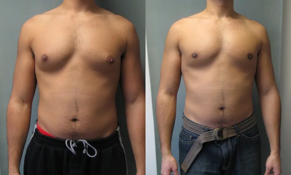 гипертрофия молочной железы у мужчин