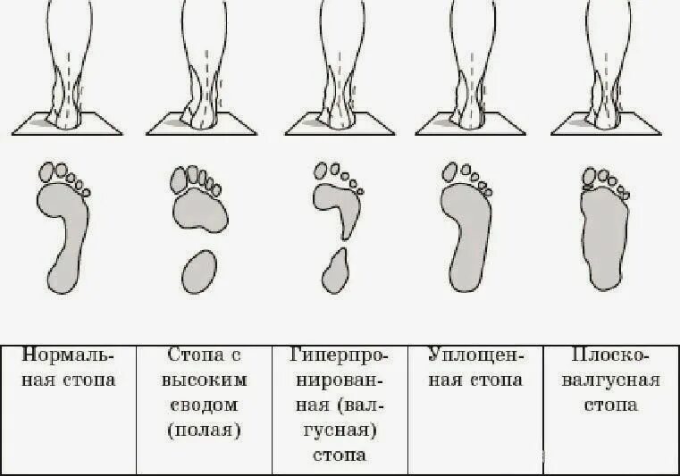 Продольный свод стопы плоскостопие. Формирование свода стопы начинается. Правильное формирование стопы. Свод стопы в норме. Плоско варусная деформация стопы.